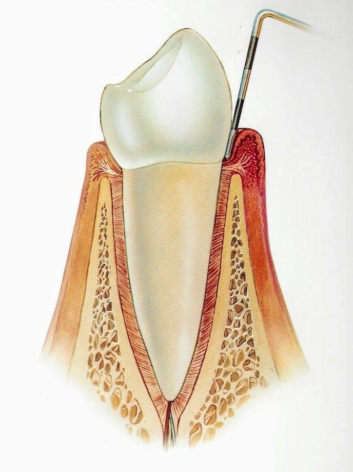 Image of Gingivitis