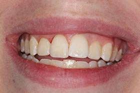 13-Opal-T-smile-a