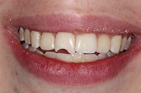 13-Opal-T-smile-b